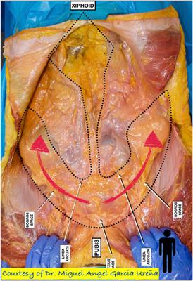 Case Report: Robotic PeTEP for Totally Extraperitoneal Repair of Incisional Hernia